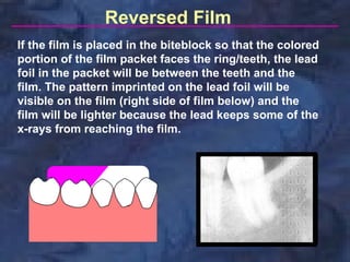 Reversed Film
If the film is placed in the biteblock so that the colored
portion of the film packet faces the ring/teeth, the lead
foil in the packet will be between the teeth and the
film. The pattern imprinted on the lead foil will be
visible on the film (right side of film below) and the
film will be lighter because the lead keeps some of the
x-rays from reaching the film.
 