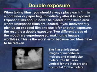 Double exposure
When taking films, you should always place each film in
a container or paper bag immediately after it is exposed.
Exposed films should never be placed in the same area
where unexposed films are located. If you inadvertently
pick up an exposed film and use it for another exposure,
the result is a double exposure. Two different areas of
the mouth are superimposed, making the images
worthless. This is the worst error because two films have
to be retaken.

                            The film at left shows
                            images of mandibular
                            incisors and mandibular
                            molars. The film was
                            vertical for the incisors and
                            horizontal for the molars.
 