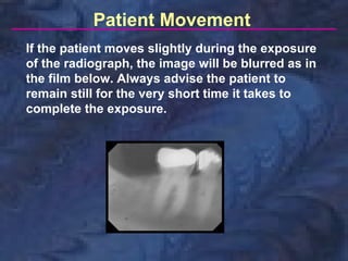 Patient Movement
If the patient moves slightly during the exposure
of the radiograph, the image will be blurred as in
the film below. Always advise the patient to
remain still for the very short time it takes to
complete the exposure.
 