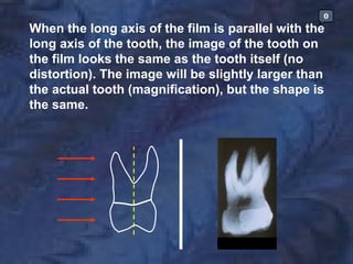 0

When the long axis of the film is parallel with the
long axis of the tooth, the image of the tooth on
the film looks the same as the tooth itself (no
distortion). The image will be slightly larger than
the actual tooth (magnification), but the shape is
the same.
 