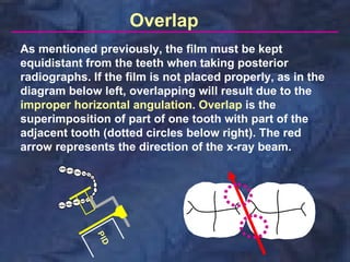 Overlap
As mentioned previously, the film must be kept
equidistant from the teeth when taking posterior
radiographs. If the film is not placed properly, as in the
diagram below left, overlapping will result due to the
improper horizontal angulation. Overlap is the
superimposition of part of one tooth with part of the
adjacent tooth (dotted circles below right). The red
arrow represents the direction of the x-ray beam.
 