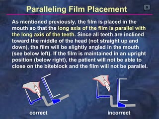 Paralleling Film Placement                        0



As mentioned previously, the film is placed in the
mouth so that the long axis of the film is parallel with
the long axis of the teeth. Since all teeth are inclined
toward the middle of the head (not straight up and
down), the film will be slightly angled in the mouth
(see below left). If the film is maintained in an upright
position (below right), the patient will not be able to
close on the biteblock and the film will not be parallel.




       correct                          incorrect
 