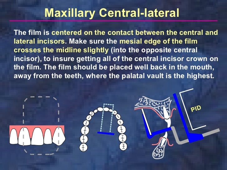 radiologyparallelingtechnique