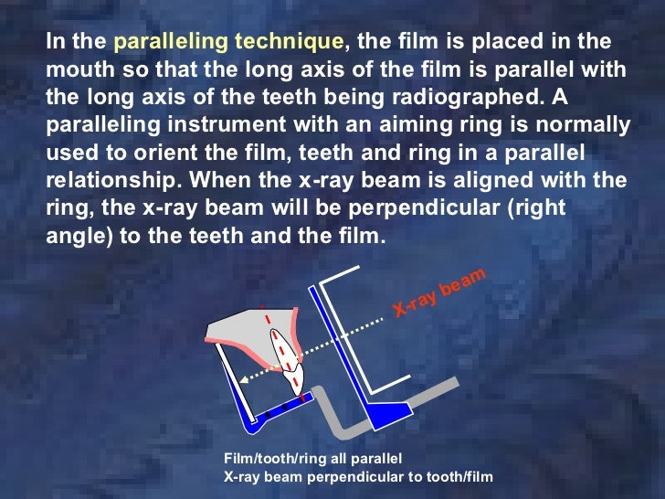 radiologyparallelingtechnique