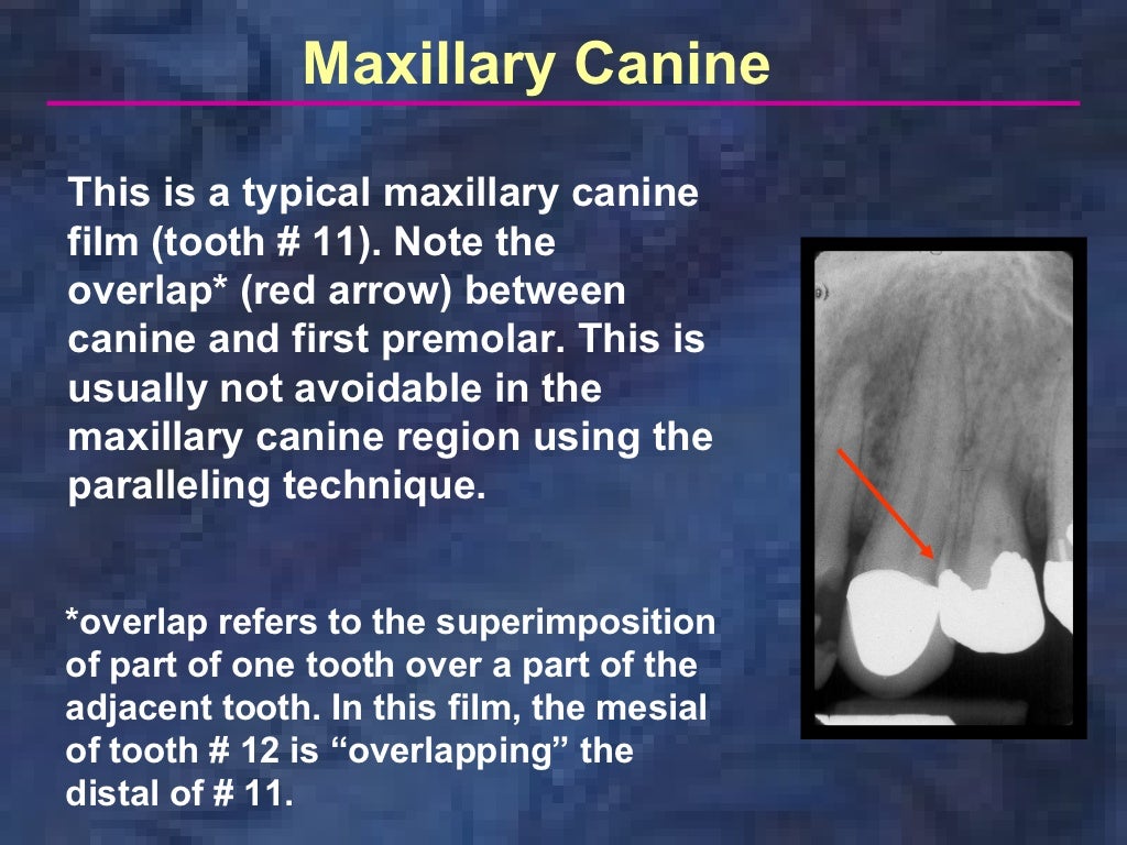 radiologyparallelingtechnique