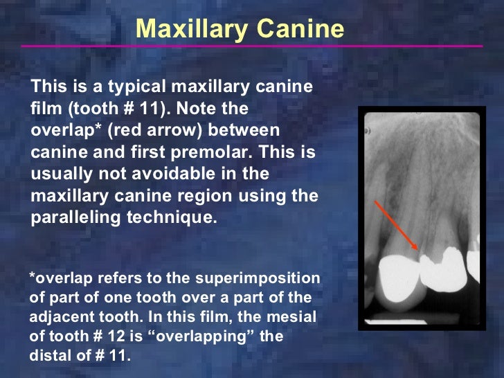 radiologyparallelingtechnique