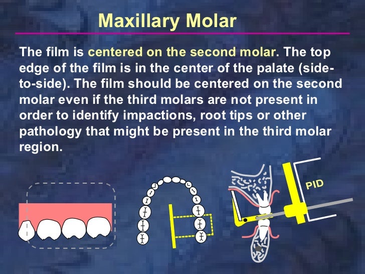 radiologyparallelingtechnique