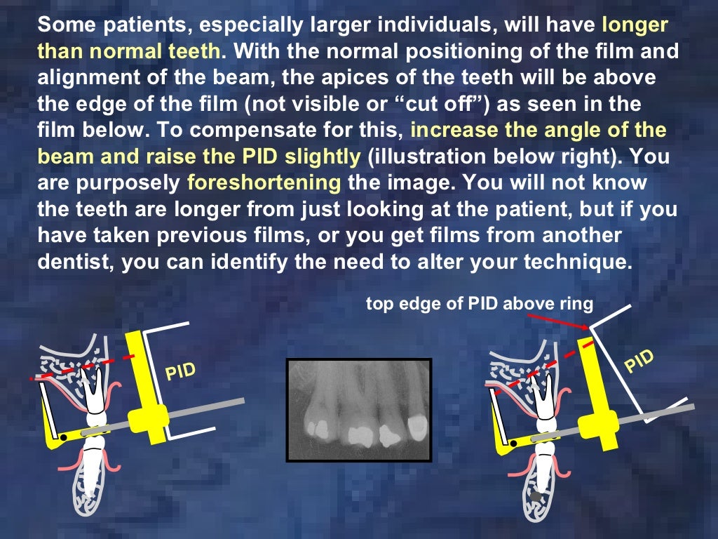 radiologyparallelingtechnique