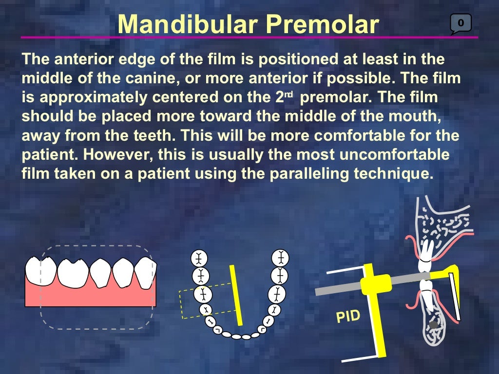radiologyparallelingtechnique