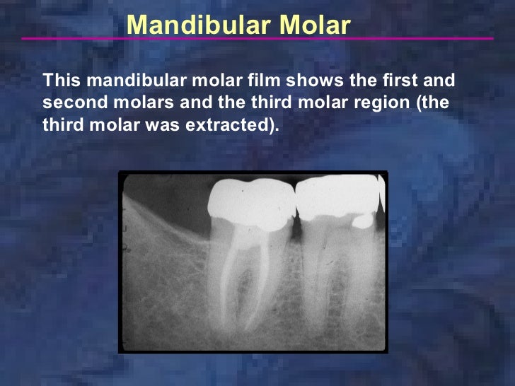 radiologyparallelingtechnique