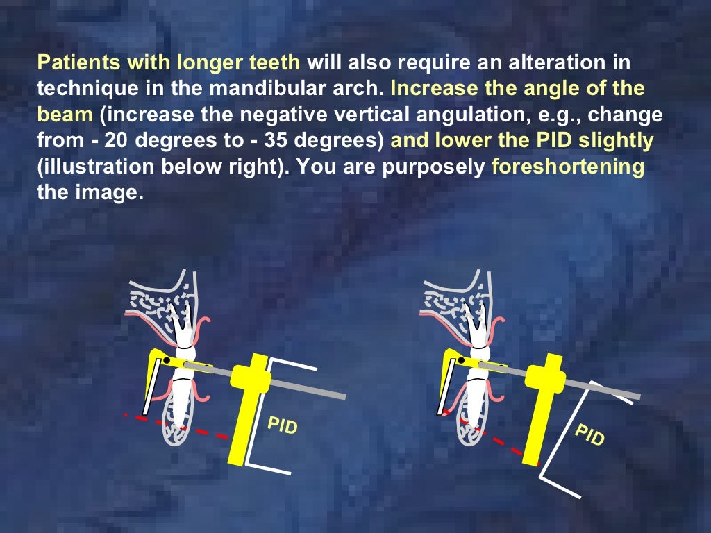 radiologyparallelingtechnique