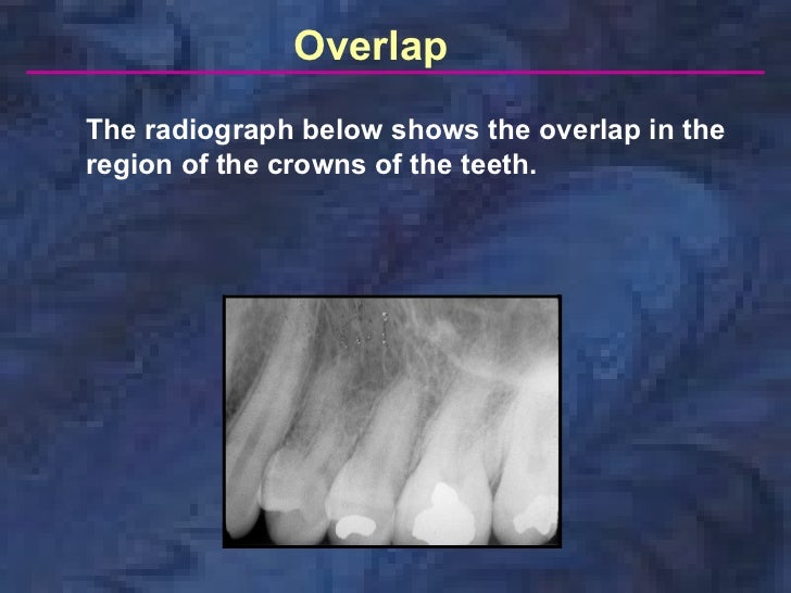 radiologyparallelingtechnique