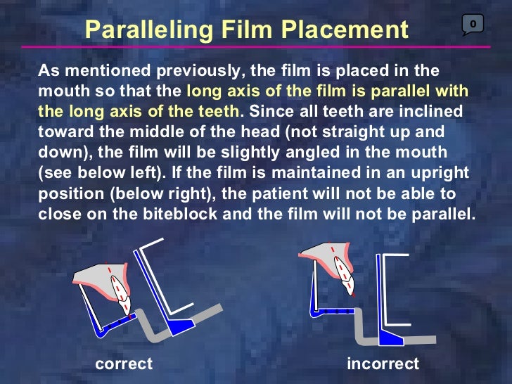 radiologyparallelingtechnique