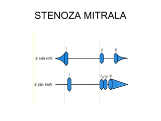 STENOZA MITRALA
 