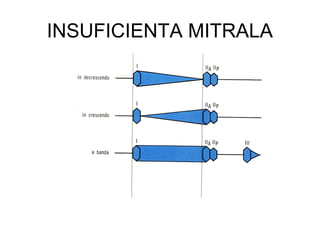 INSUFICIENTA MITRALA
 