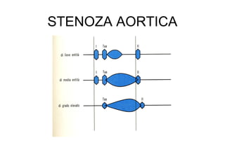 STENOZA AORTICA
 