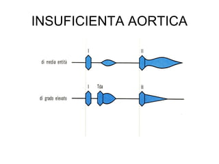 INSUFICIENTA AORTICA
 