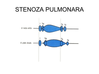 STENOZA PULMONARA
 