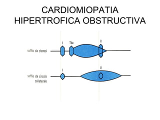 CARDIOMIOPATIA
HIPERTROFICA OBSTRUCTIVA
 