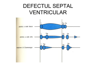DEFECTUL SEPTAL
VENTRICULAR
 