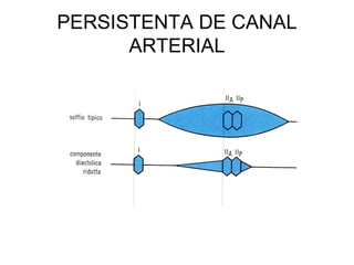 PERSISTENTA DE CANAL
ARTERIAL
 
