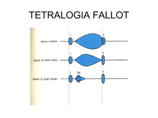 TETRALOGIA FALLOT
 