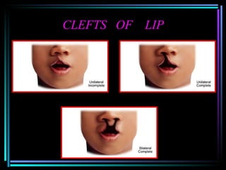 CLEFTS  OF  LIP 