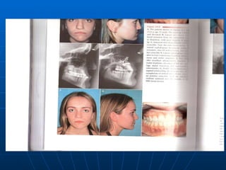 cleft management | PPT