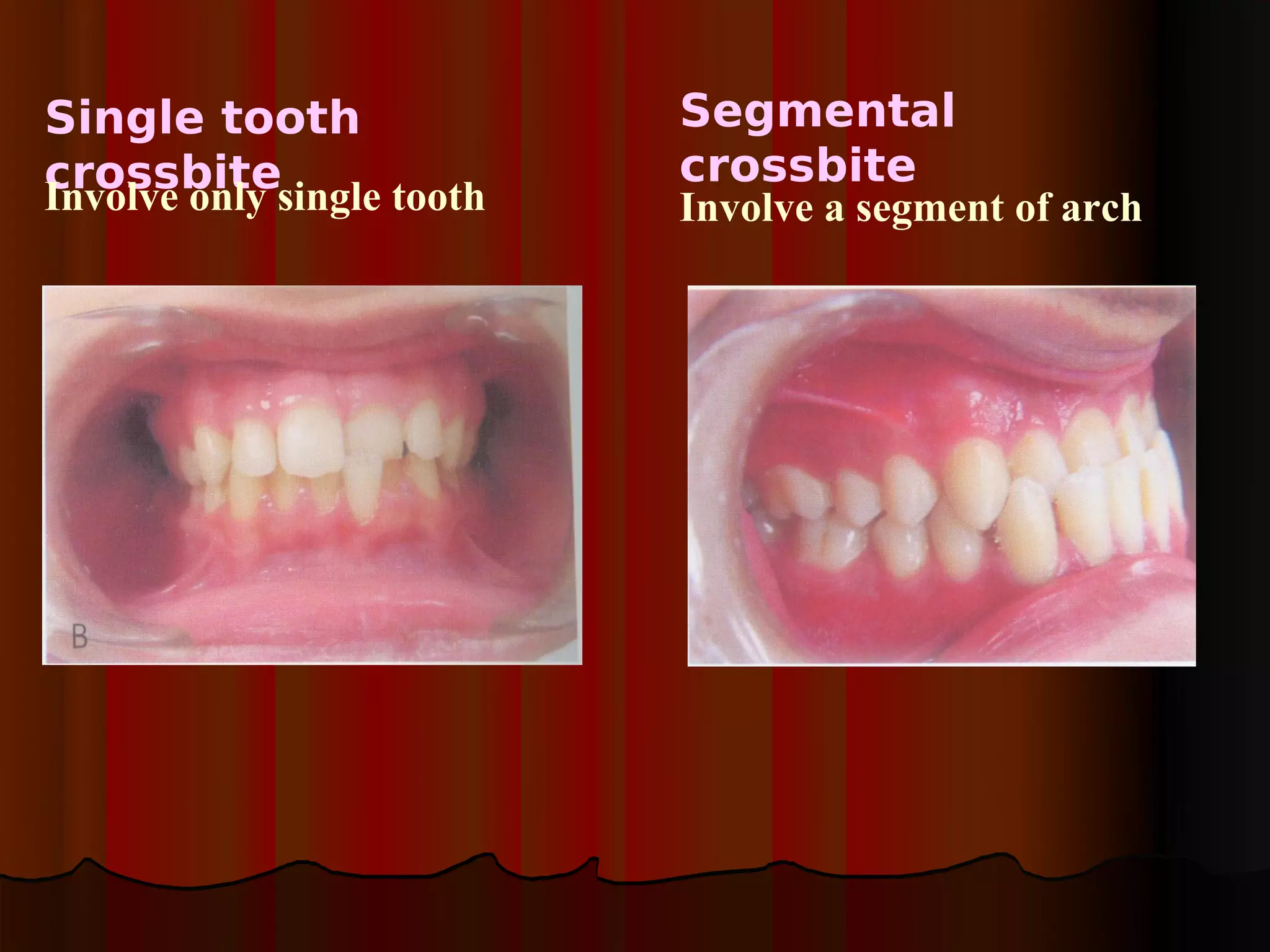 Single tooth            Segmental
crossbitesingle tooth   crossbite
Involve only            Involve a segment of arch
 