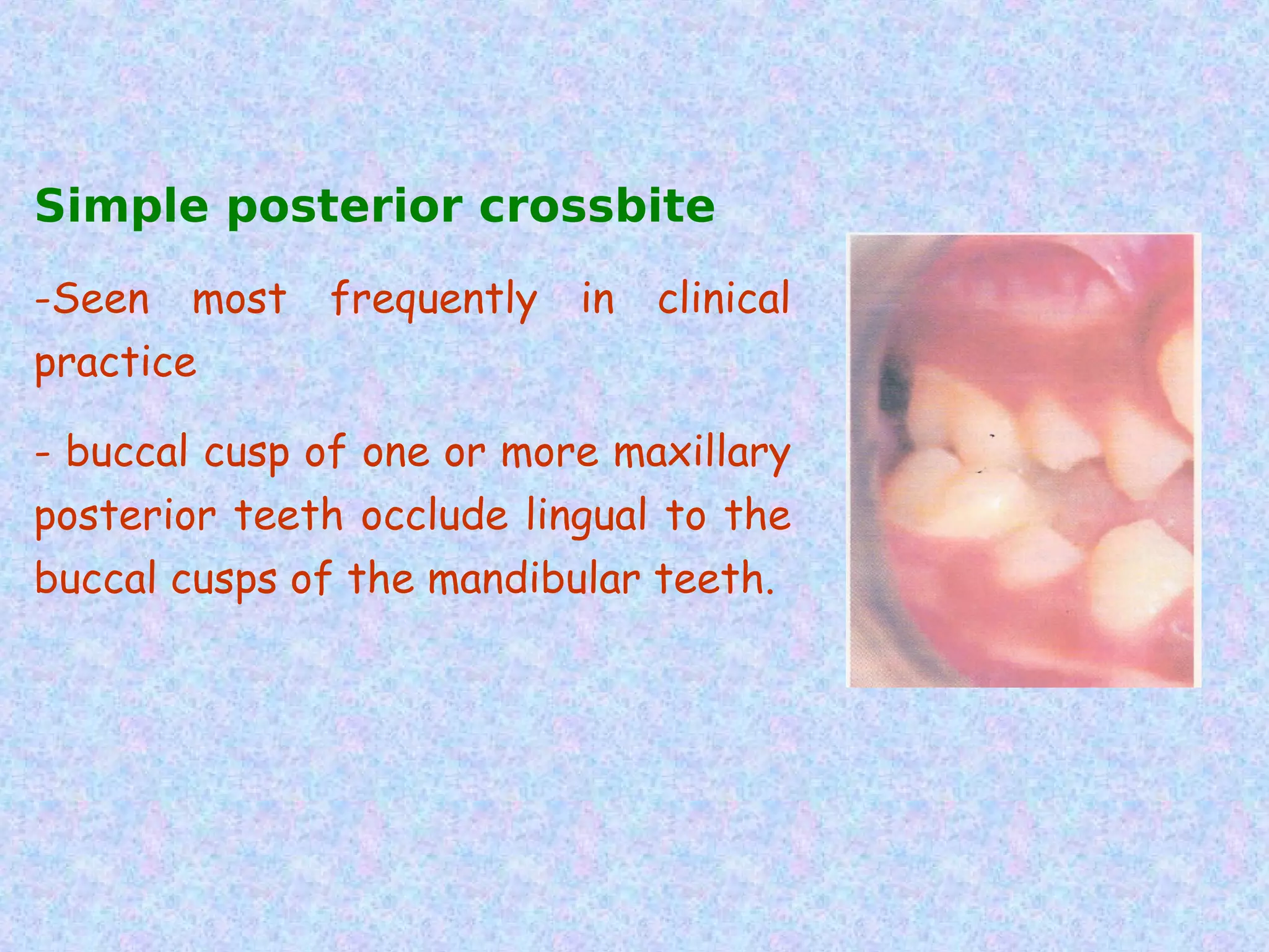 Simple posterior crossbite
-Seen most    frequently   in   clinical
practice

- buccal cusp of one or more maxillary
posterior teeth occlude lingual to the
buccal cusps of the mandibular teeth.
 
