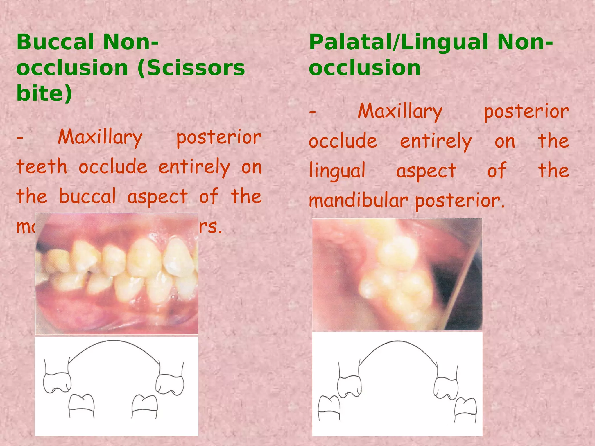 Buccal Non-                 Palatal/Lingual Non-
occlusion (Scissors         occlusion
bite)
                            -     Maxillary   posterior
-   Maxillary   posterior   occlude entirely on the
teeth occlude entirely on   lingual  aspect    of  the
the buccal aspect of the    mandibular posterior.
mandibular posteriors.
 