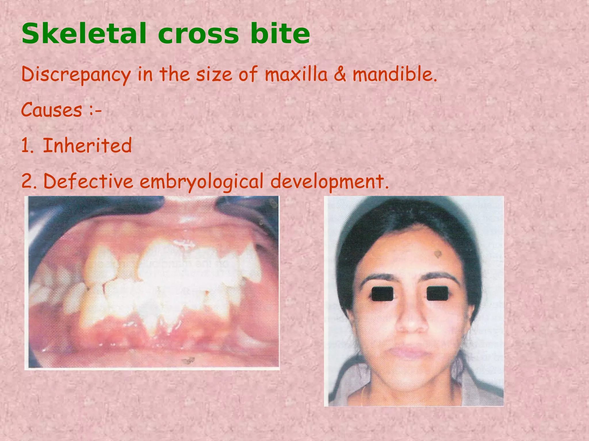 Skeletal cross bite
Discrepancy in the size of maxilla & mandible.
Causes :-
1. Inherited
2. Defective embryological development.
 