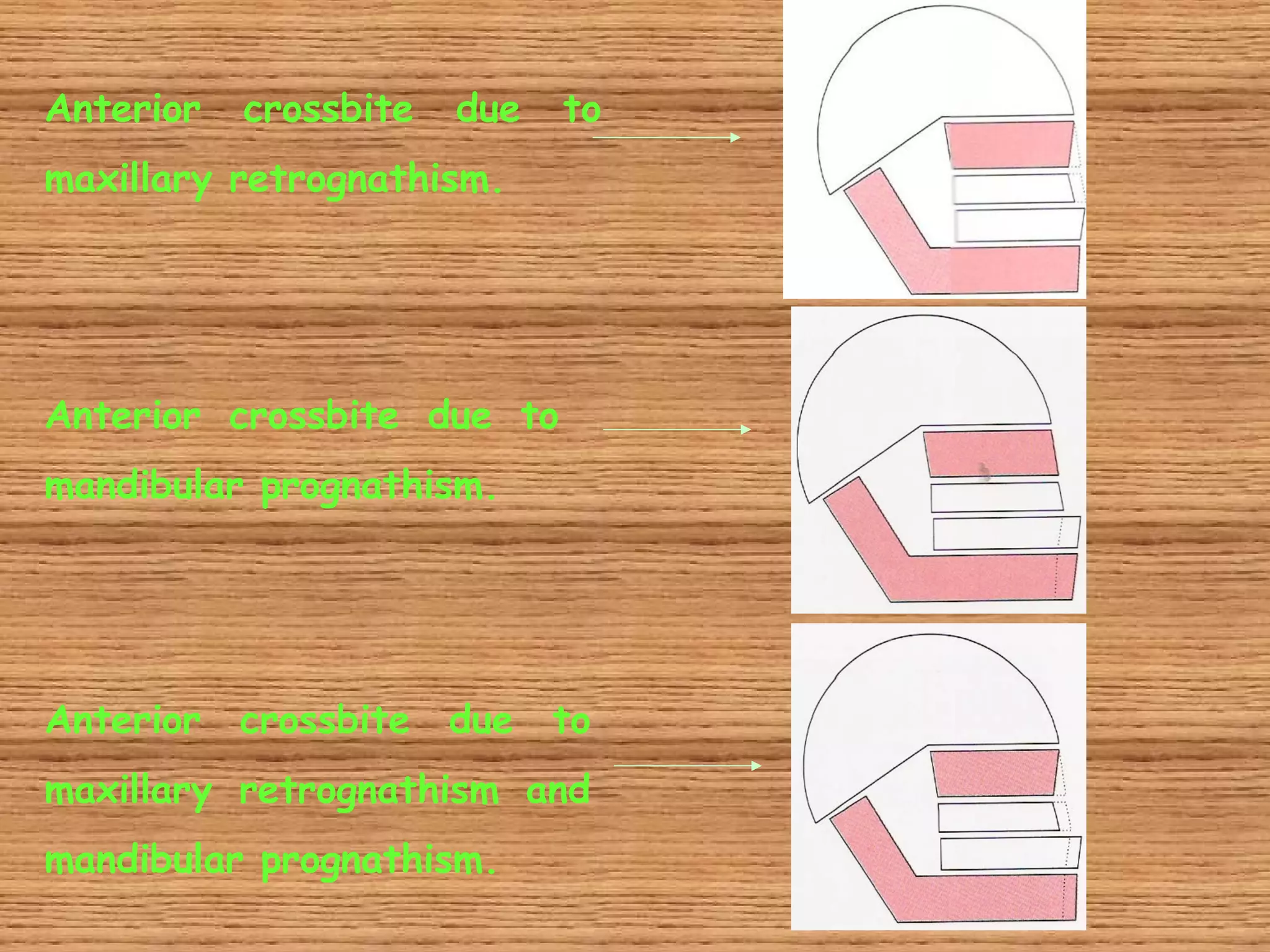 Anterior   crossbite   due   to
maxillary retrognathism.




Anterior crossbite due to
mandibular prognathism.




Anterior   crossbite due to
maxillary retrognathism and
mandibular prognathism.
 