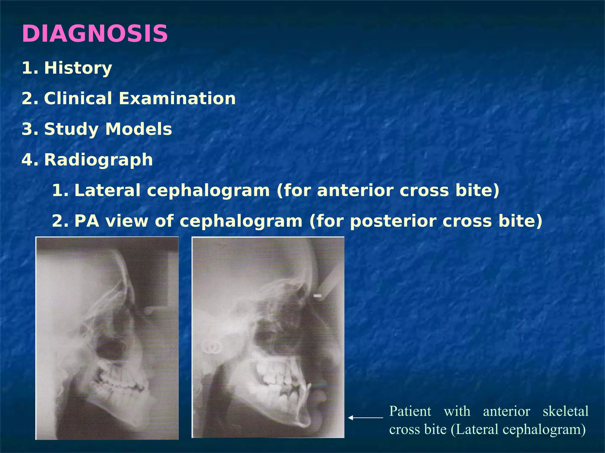 DIAGNOSIS
1. History
2. Clinical Examination
3. Study Models
4. Radiograph
   1. Lateral cephalogram (for anterior cross bite)
   2. PA view of cephalogram (for posterior cross bite)




                                       Patient with anterior skeletal
                                       cross bite (Lateral cephalogram)
 