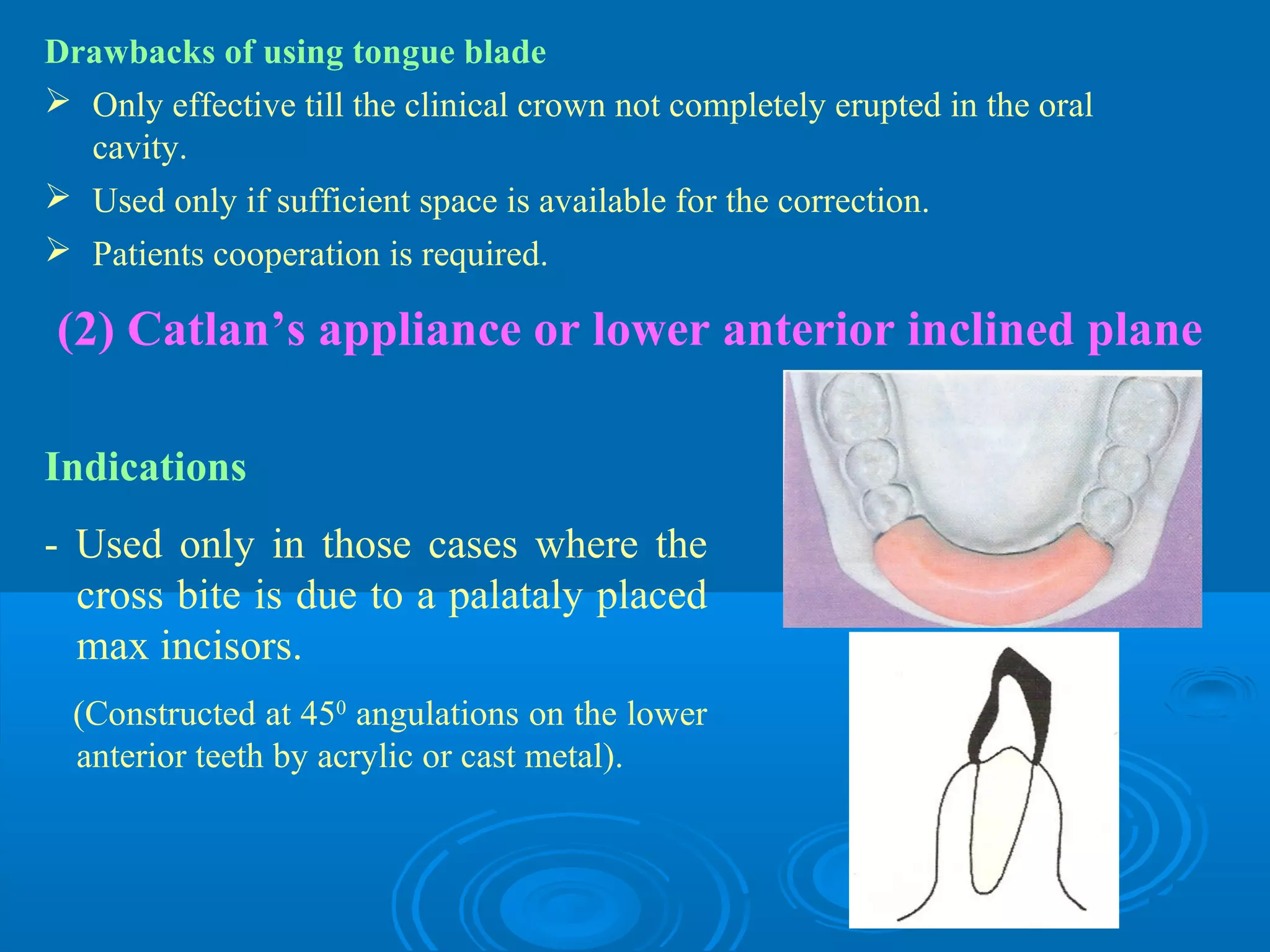 Drawbacks of using tongue blade
 Only effective till the clinical crown not completely erupted in the oral
  cavity.
 Used only if sufficient space is available for the correction.
 Patients cooperation is required.

(2) Catlan’s appliance or lower anterior inclined plane

Indications
- Used only in those cases where the
  cross bite is due to a palataly placed
  max incisors.
  (Constructed at 450 angulations on the lower
  anterior teeth by acrylic or cast metal).
 