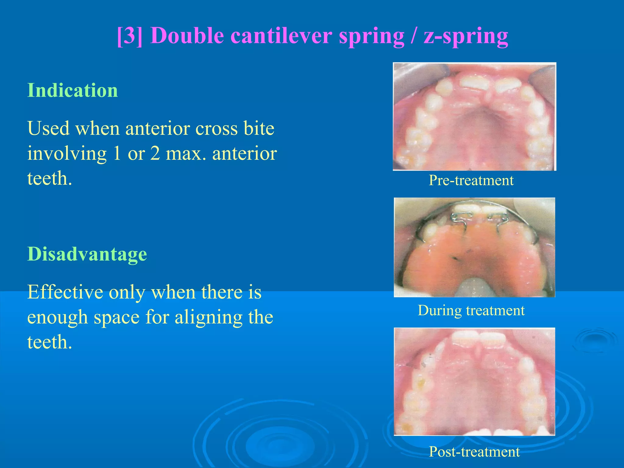 [3] Double cantilever spring / z-spring

Indication
Used when anterior cross bite
involving 1 or 2 max. anterior
teeth.                                   Pre-treatment



Disadvantage
Effective only when there is
                                       During treatment
enough space for aligning the
teeth.




                                         Post-treatment
 