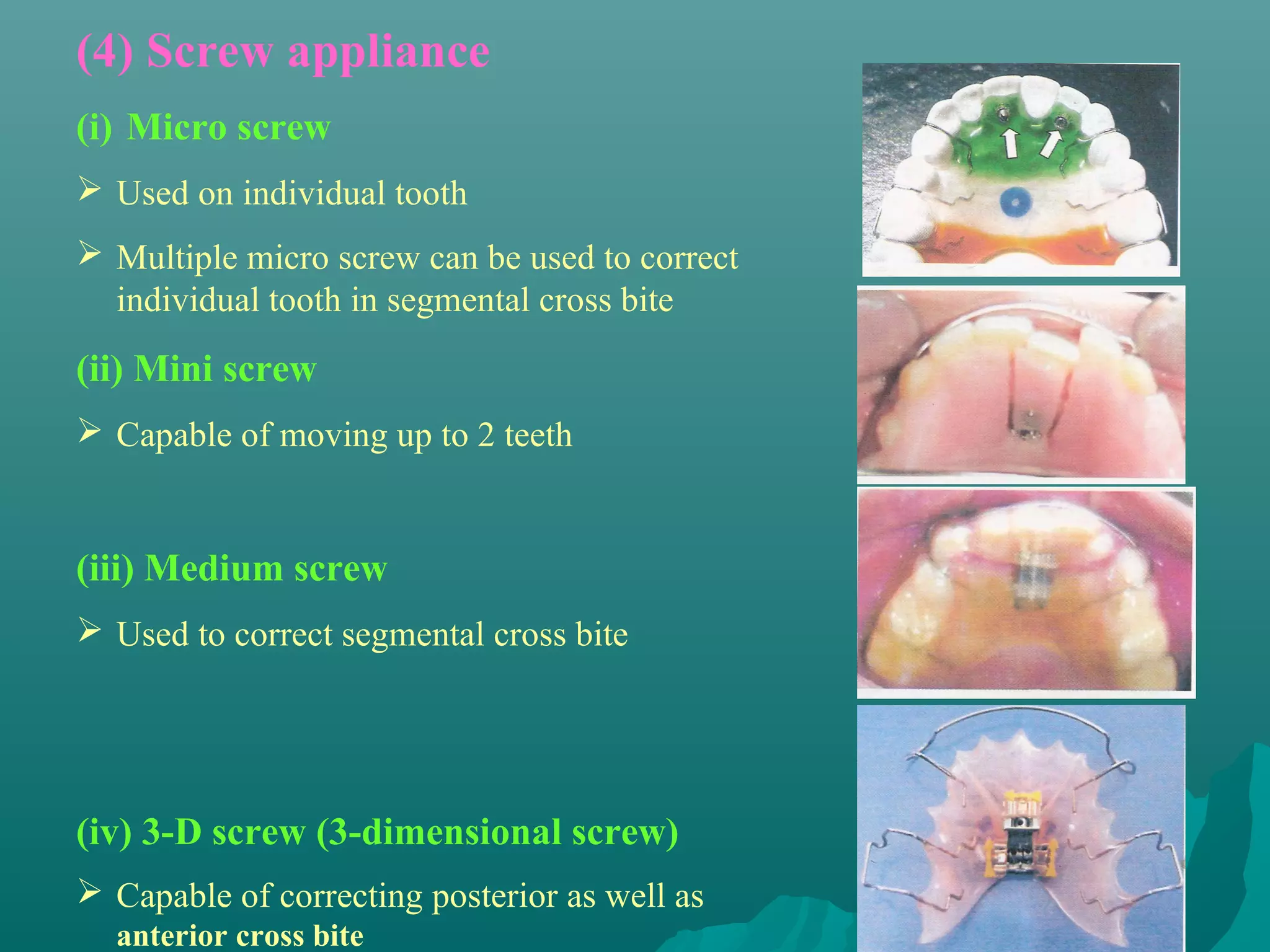 (4) Screw appliance
(i) Micro screw
 Used on individual tooth
 Multiple micro screw can be used to correct
  individual tooth in segmental cross bite
(ii) Mini screw
 Capable of moving up to 2 teeth


(iii) Medium screw
 Used to correct segmental cross bite




(iv) 3-D screw (3-dimensional screw)
 Capable of correcting posterior as well as
  anterior cross bite
 