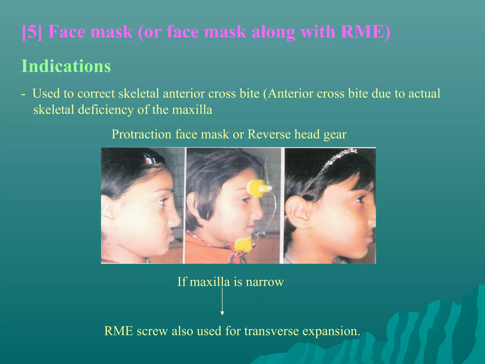 [5] Face mask (or face mask along with RME)
Indications
- Used to correct skeletal anterior cross bite (Anterior cross bite due to actual
  skeletal deficiency of the maxilla
                 Protraction face mask or Reverse head gear




                              If maxilla is narrow


                RME screw also used for transverse expansion.
 