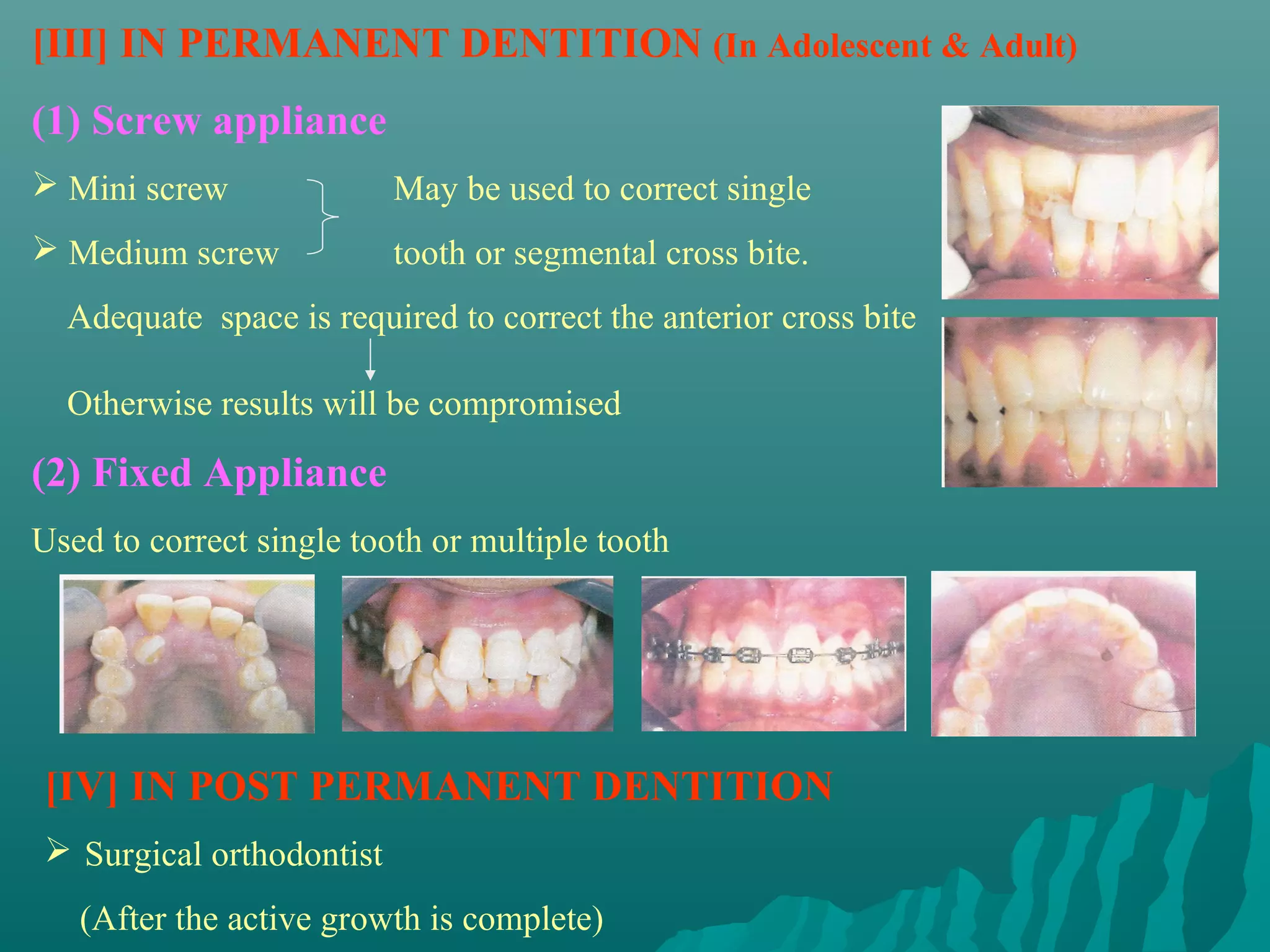 [III] IN PERMANENT DENTITION (In Adolescent & Adult)
(1) Screw appliance
 Mini screw              May be used to correct single
 Medium screw            tooth or segmental cross bite.
  Adequate space is required to correct the anterior cross bite

  Otherwise results will be compromised

(2) Fixed Appliance
Used to correct single tooth or multiple tooth




[IV] IN POST PERMANENT DENTITION
 Surgical orthodontist
   (After the active growth is complete)
 