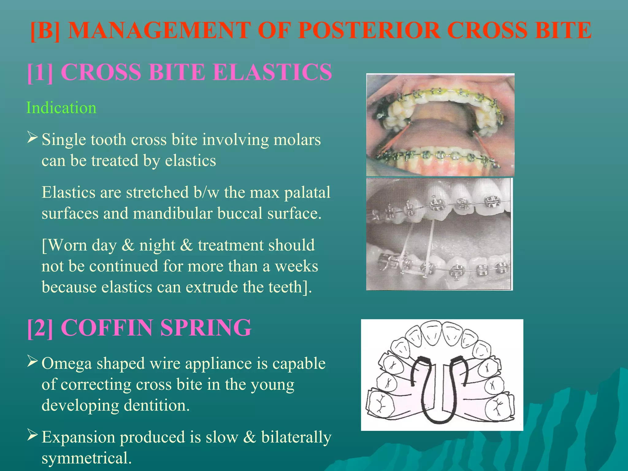 [B] MANAGEMENT OF POSTERIOR CROSS BITE
[1] CROSS BITE ELASTICS
Indication
 Single tooth cross bite involving molars
  can be treated by elastics
  Elastics are stretched b/w the max palatal
  surfaces and mandibular buccal surface.
  [Worn day & night & treatment should
  not be continued for more than a weeks
  because elastics can extrude the teeth].

[2] COFFIN SPRING
 Omega shaped wire appliance is capable
  of correcting cross bite in the young
  developing dentition.
 Expansion produced is slow & bilaterally
  symmetrical.
 