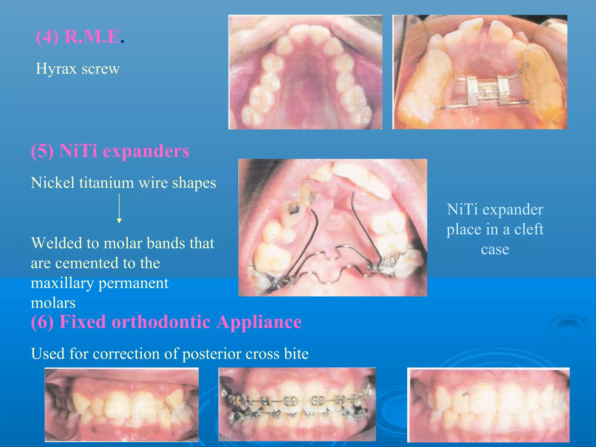 (4) R.M.E.
Hyrax screw




(5) NiTi expanders
Nickel titanium wire shapes
                                              NiTi expander
                                              place in a cleft
Welded to molar bands that                         case
are cemented to the
maxillary permanent
molars
(6) Fixed orthodontic Appliance
Used for correction of posterior cross bite
 