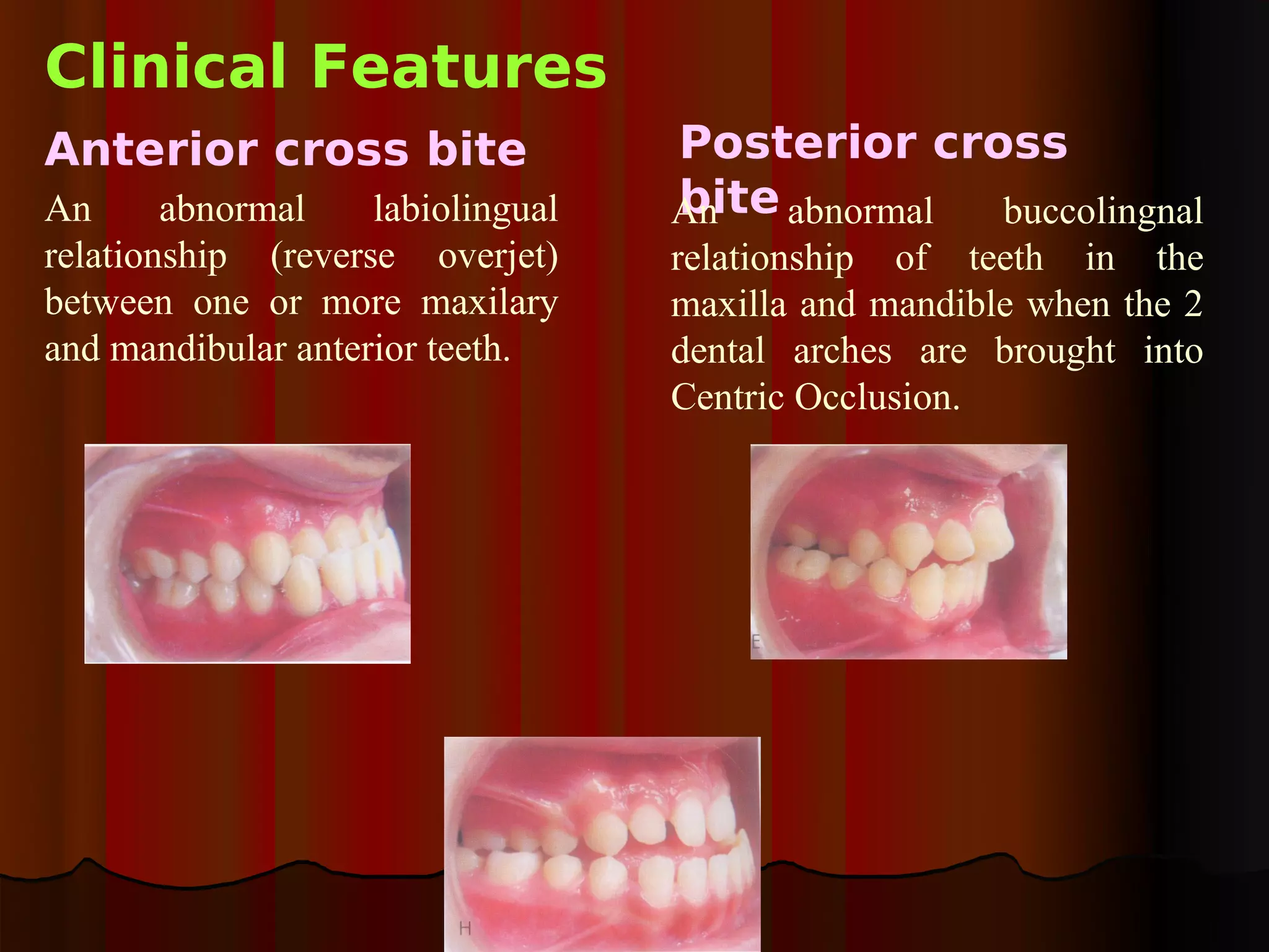 Clinical Features
Anterior cross bite                Posterior cross
An      abnormal    labiolingual   bite abnormal
                                   An            buccolingnal
relationship (reverse overjet)     relationship of teeth in the
between one or more maxilary       maxilla and mandible when the 2
and mandibular anterior teeth.     dental arches are brought into
                                   Centric Occlusion.
 