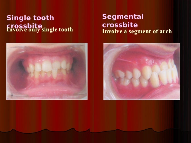 crossbite crossbite