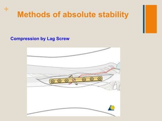 principles of fracture fixation | PPTX