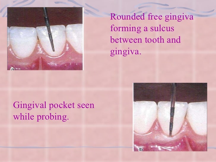 gingiva