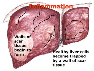 Inflammation
Walls of
scar
tissue
begin to
form
Healthy liver cells
become trapped
by a wall of scar
tissue
 