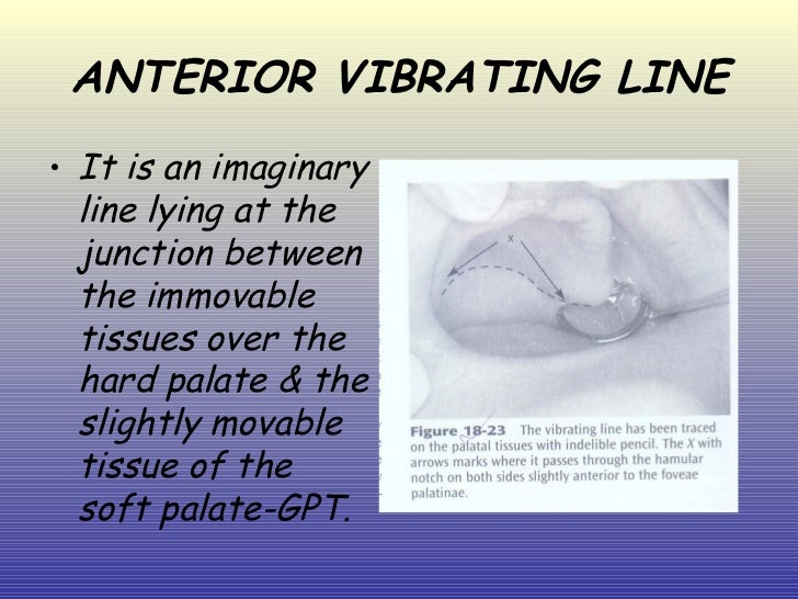 posterior palatal seal