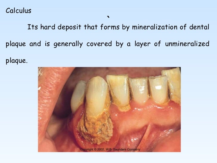 mechanical plaque control pedo how long does a cavity take to form
