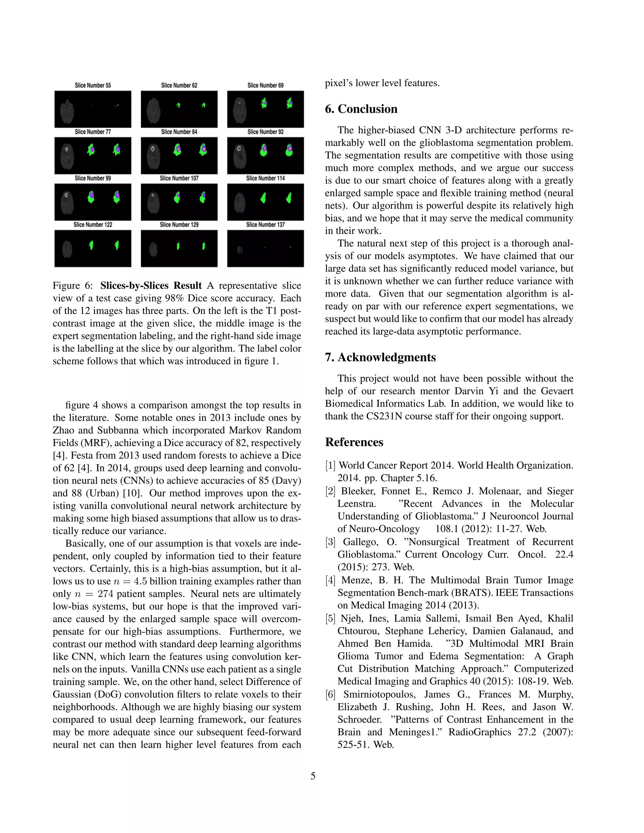 Figure 6: Slices-by-Slices Result A representative slice view of a test case giving 98% Dice score accuracy. Each of the 12 images has three parts. On the left is the T1 post- contrast image at the given slice, the middle image is the expert segmentation labeling, and the right-hand side image is the labelling at the slice by our algorithm. The label color scheme follows that which was introduced in ﬁgure 1. ﬁgure 4 shows a comparison amongst the top results in the literature. Some notable ones in 2013 include ones by Zhao and Subbanna which incorporated Markov Random Fields (MRF), achieving a Dice accuracy of 82, respectively [4]. Festa from 2013 used random forests to achieve a Dice of 62 [4]. In 2014, groups used deep learning and convolu- tion neural nets (CNNs) to achieve accuracies of 85 (Davy) and 88 (Urban) [10]. Our method improves upon the ex- isting vanilla convolutional neural network architecture by making some high biased assumptions that allow us to dras- tically reduce our variance. Basically, one of our assumption is that voxels are inde- pendent, only coupled by information tied to their feature vectors. Certainly, this is a high-bias assumption, but it al- lows us to use n = 4.5 billion training examples rather than only n = 274 patient samples. Neural nets are ultimately low-bias systems, but our hope is that the improved vari- ance caused by the enlarged sample space will overcom- pensate for our high-bias assumptions. Furthermore, we contrast our method with standard deep learning algorithms like CNN, which learn the features using convolution ker- nels on the inputs. Vanilla CNNs use each patient as a single training sample. We, on the other hand, select Difference of Gaussian (DoG) convolution ﬁlters to relate voxels to their neighborhoods. Although we are highly biasing our system compared to usual deep learning framework, our features may be more adequate since our subsequent feed-forward neural net can then learn higher level features from each pixel’s lower level features. 6. Conclusion The higher-biased CNN 3-D architecture performs re- markably well on the glioblastoma segmentation problem. The segmentation results are competitive with those using much more complex methods, and we argue our success is due to our smart choice of features along with a greatly enlarged sample space and ﬂexible training method (neural nets). Our algorithm is powerful despite its relatively high bias, and we hope that it may serve the medical community in their work. The natural next step of this project is a thorough anal- ysis of our models asymptotes. We have claimed that our large data set has signiﬁcantly reduced model variance, but it is unknown whether we can further reduce variance with more data. Given that our segmentation algorithm is al- ready on par with our reference expert segmentations, we suspect but would like to conﬁrm that our model has already reached its large-data asymptotic performance. 7. Acknowledgments This project would not have been possible without the help of our research mentor Darvin Yi and the Gevaert Biomedical Informatics Lab. In addition, we would like to thank the CS231N course staff for their ongoing support. References [1] World Cancer Report 2014. World Health Organization. 2014. pp. Chapter 5.16. [2] Bleeker, Fonnet E., Remco J. Molenaar, and Sieger Leenstra. ”Recent Advances in the Molecular Understanding of Glioblastoma.” J Neurooncol Journal of Neuro-Oncology 108.1 (2012): 11-27. Web. [3] Gallego, O. ”Nonsurgical Treatment of Recurrent Glioblastoma.” Current Oncology Curr. Oncol. 22.4 (2015): 273. Web. [4] Menze, B. H. The Multimodal Brain Tumor Image Segmentation Bench-mark (BRATS). IEEE Transactions on Medical Imaging 2014 (2013). [5] Njeh, Ines, Lamia Sallemi, Ismail Ben Ayed, Khalil Chtourou, Stephane Lehericy, Damien Galanaud, and Ahmed Ben Hamida. ”3D Multimodal MRI Brain Glioma Tumor and Edema Segmentation: A Graph Cut Distribution Matching Approach.” Computerized Medical Imaging and Graphics 40 (2015): 108-19. Web. [6] Smirniotopoulos, James G., Frances M. Murphy, Elizabeth J. Rushing, John H. Rees, and Jason W. Schroeder. ”Patterns of Contrast Enhancement in the Brain and Meninges1.” RadioGraphics 27.2 (2007): 525-51. Web. 5 