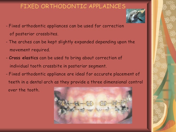 posterior crossbite in primary and mixed dentition etiology and mana…